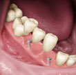implant teeth