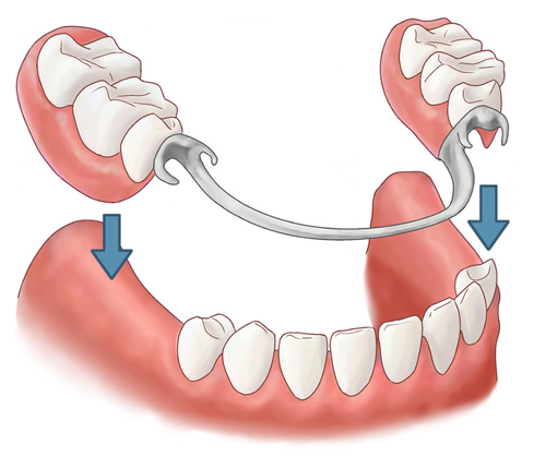 partial dentures gentle dental
