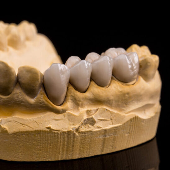 dental bridge