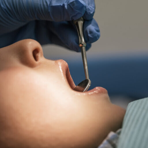 Fillings at Macedon Street Dental